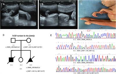 Frontiers Case Report Identification Of One Frameshift Variant And